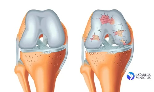 Redução da Inflamação